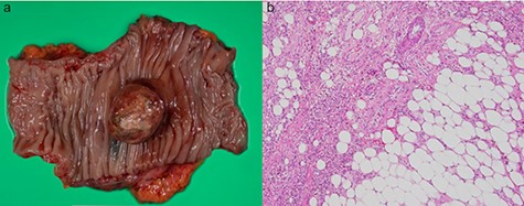 Resected specimen and pathological findings: (a) Resected specimen with a tumor size of 3.0 × 2.5 cm in diameter. The surface of tumor was relatively smooth, similar to that of a submucosal tumor. (b) Pathological findings: The outgrowth of mature fat tissue and vessel tissue were found in the tumor tissue (Hematoxylin & Eosin, ×400).