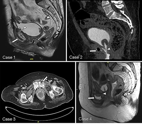 Representative CT and MRI imaging demonstrating USF (white arrowhead) and features suggesting pubic osteomyelitis (white arrow) in each respective case.