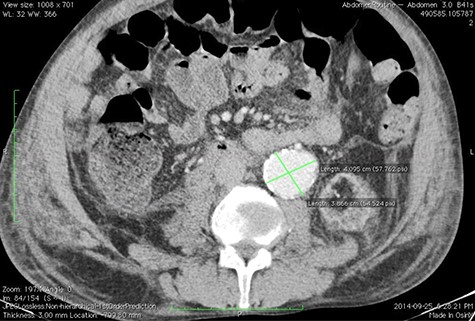 Pre-operative CT scan.