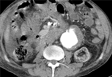 Post-operative contrast-enhanced CT scan, late arterial phase.