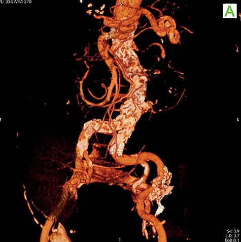 Follow-up CT angiography.