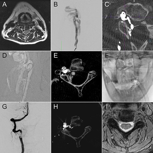 (A) Cervical MR revealed an enlarged epidural flow-void signal near the right C4–5 intervertebral foramen. (B) Anteroposterior (AP) view of the right VA angiography demonstrated a high-flow VVF at the C2–3 level. (C) An oblique axial reconstruction of IA-CBCTA revealed the detailed angioarchitectural arrangement of the VVF, as well as its anatomical relations to the foramen transversarium, intervertebral foramen and the spinal canal. The proposed embolization target for dense coil packing was limited to the venous channel outside the intervertebral foramen. (D) Roadmap fluoroscope demonstrated the position of the microcatheter tip within the target. (E) IA-CBCTA performed after placing one framing coil confirmed the proper position of the coil. (F) This first coil therefore served as the frame for the following dense coiling under fluoroscopy. (G) AP view of the control right VA angiography demonstrated complete obliteration of the VVF. (H) Postop IA-CBCTA demonstrated the dense coil mass within the foramen transversarium, and a single coil loop within the intervertebral foramen. (I) Postop MR showed disappearance of the engorged epidural venous channels. Arrowhead, drainage vein within the foramen transversarium (the embolization target for dense coiling); Asterisk, right VA; dashed arrow: drainage vein within the intervertebral foramen; Solid arrow, drainage vein within the spinal canal.