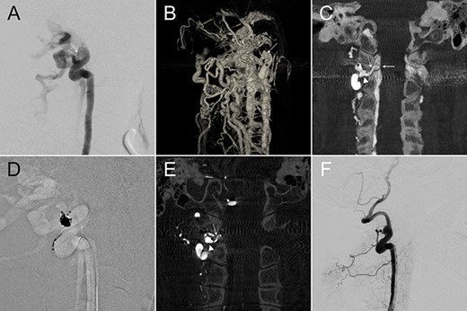 (A,B) Lateral and 3D views of the right VA angiography demonstrated a high-flow VVF at the C1–2 level. (C) An oblique coronal reconstruction of IA-CBCTA revealed the detailed angioarchitectural arrangement of the VVF, as well as its anatomical relations to the foramen transversarium, intervertebral foramen and the spinal canal. The proposed embolization target for dense coil packing was limited to the venous channel outside the intervertebral foramen. (D) Roadmap fluoroscope demonstrated the location of the dense coil mass. (E) Postop IA-CBCTA demonstrated the dense coil mass within the foramen transversarium, and a single coil loop within the intervertebral foramen. (F) Lateral view of the control right VA angiography demonstrated complete obliteration of the VVF. Arrowhead, drainage vein near the foramen transversarium (the embolization target for dense coiling); Asterisk, right VA; dashed arrow: drainage vein within the intervertebral foramen; solid arrow, drainage vein within the spinal canal.