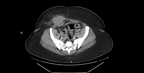 CT (axial view) demonstrating high-density soft tissue opacity measuring 5.8 × 4.4 cm in the subcutaneous tissue of the right lower quadrant abutting the anterior aspect of the abdominal wall.