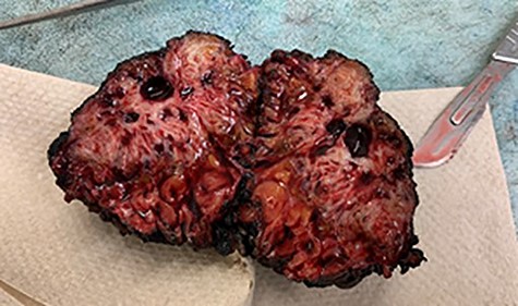 Gross cross section of the abdominal wall endometrioma.