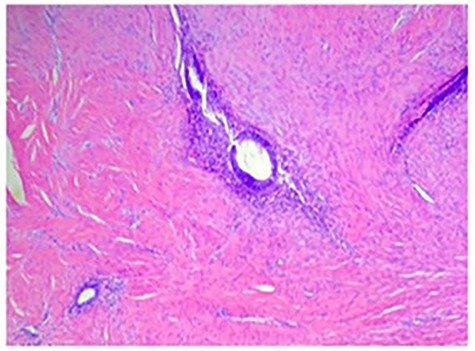 H&E stain demonstrating fibroadipose tissue with interspaced endometrial glands and stroma consistent with endometriosis.