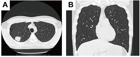 Computed tomography showed a 33 mm mass in the right upper lobe. A. No interlobar fissure between the right upper lobe and middle lobe