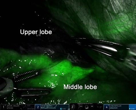 Intravenous indocyanine green delineation of the interlobar border between the right upper and middle lobe.