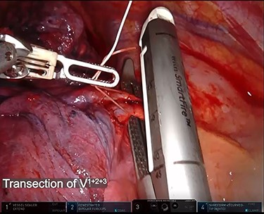Indocyanine green was intravenously injected after transection of the pulmonary artery, vein and bronchus by robotic staplers. The interlobar fissure was identified by near-infrared fluorescence imaging camera and divided by robotic staplers.