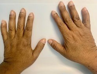 Hand digital clubbing.