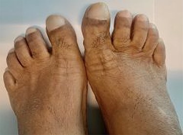 Feet clubbing.
