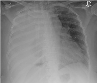 Initial CXR with compressed right lung, possible mass lesion and pleural effusion.
