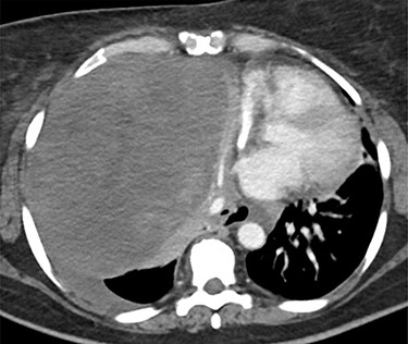 Chest CT scan. Large heterogenous mass in the right hemithorax, displacing the heart, great vessels and trachea, and esophagus to the left of midline. The origin may be hilar. No definite calcifications. Unrelated to vessels, and with associated left pleural effusion.