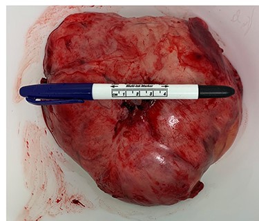Final dimensions of the mass were 19.2 cm × 17.5 cm × 10.5 cm.