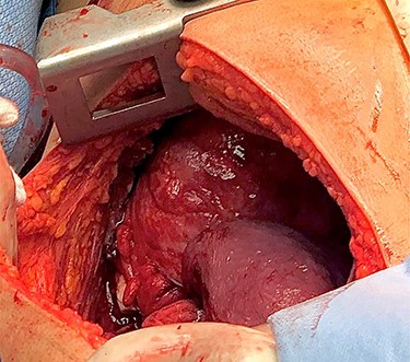 Right thoracic cavity after mass excision showing complete right lung collapse.