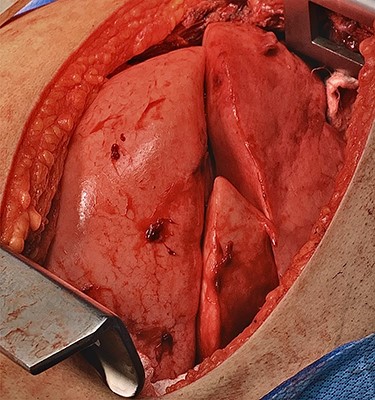 Right lung complete re-expansion of all three lobes after starting right lung ventilation.