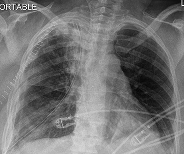 Postoperative CXR revealing complete lung expansion, no associated pneumothorax, no effusion.