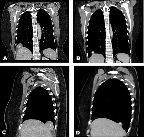 CT characterisation of supradiaphragmatic mass in 2 different views (mass marked with ‘*’) demonstrating a clear cleavage plane separating the mass and liver in 2020 and 2018. (A) CT scan of thorax in 2020—coronal view. (B) CT scan of thorax in 2018—coronal view. (C) CT scan of thorax in 2020—sagittal view of right hemithorax. (D) CT scan of thorax in 2018—sagittal view of right hemithorax.