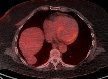 PET scan of Thorax demonstrating a smooth mildly avid peripheral/pleural-based right lower lobe mass with SUVmax of 4.3, which was contiguous with the right hemidiaphragm.