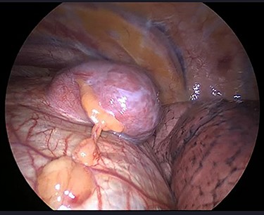 Supradiaphragmatic mass attached to the right hemidiaphragm.
