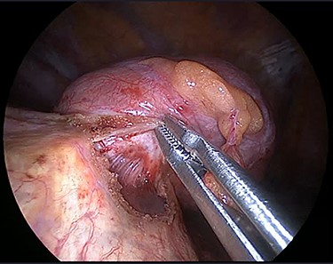 Clear plane between the mass and liver