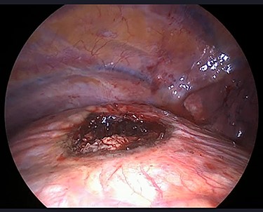Diaphragmatic defect after mass excision.
