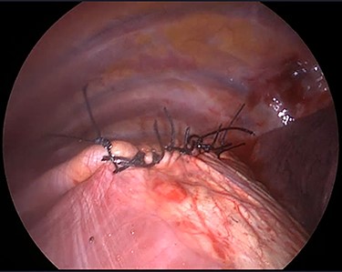 Diaphragmatic defect was closed in a single layer with simple interrupted stitches.