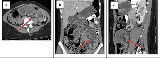 Cross-sectional imaging of displaying bowel and mesentery (arrow) intussuscepting into the JJ anastomosis on (a) transverse view, (b) coronal view and (c) sagittal view.