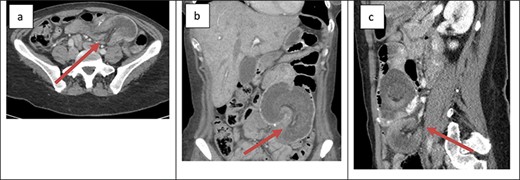 Cross-sectional imaging of displaying bowel and mesentery (arrow) intussuscepting into the JJ anastomosis on (a) transverse view, (b) coronal view and (c) sagittal view.