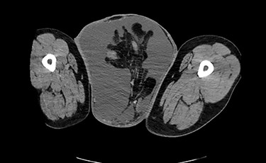 CT (axial view) demonstrating large left inguinal hernia sac containing bowel, fluid and left ureter.