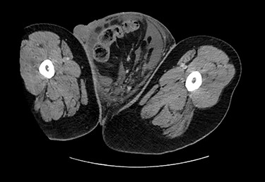 CT (axial view).
