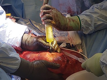 Intraoperative picture demonstrating fluid being drawn from hernia sac.