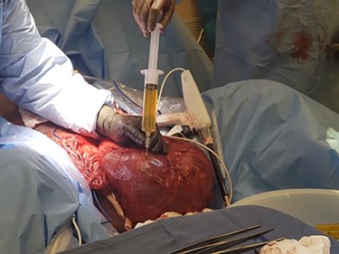 Intraoperative picture of hernia sac after decompression.