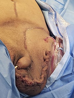 Postoperative closure of hernia.