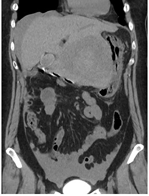 Abdominal CT at the onset of symptoms suggestive of acute abdomen. A 10 cm diameter liver tumor was seen to protrude from the left lateral segment of the liver and high-density ascites was identified around the liver.