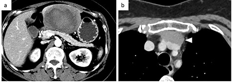 Contrast-enhanced CT. (a) Abdominal CT: a solitary liver tumor, 10 cm in diameter, was located in the left lateral segment of the liver. The tumor had a clear margin, with tumor enhancement in both the arterial and portal phases. (b) Chest CT: an enhanced tumor with an irregular margin was detected in the anterior mediastinum. The tumor had a maximum diameter of 4.5 cm.