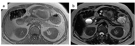 MRI. (a) T1-weighted image: low-intensity area suggestive of intratumor hemorrhage. (b) T2-weighted image: the tumor had heterogenous intensity.