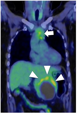 Fluorodeoxyglucose positron emission tomography. Maximum standard uptake value of the liver tumor (arrow head) was 4.8 and that of the anterior mediastinal tumor (arrow) was 3.9. Neither lymph node metastasis nor other distant metastasis was detected.