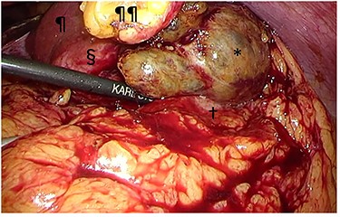 Intraoperative findings. The tumor (§) with its protruding content (*) was adherent to the greater omentum and stomach (†). The tumor was bluntly dissected and no peritoneal dissemination was observed. ¶liver; ¶¶divided round ligament.