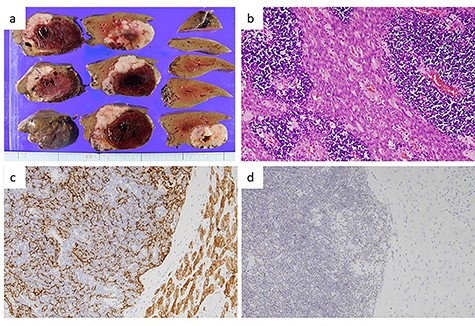 Pathological findings of the liver tumor. (a) Gross view of a cross-section of the liver tumor. The lesion, measuring 7.5 × 7.5 × 4 cm, was seen to consist of a grayish-white solid tumor with a massive intratumor hematoma. (b) Hematoxylin–eosin staining of the liver tumor (×200) showed a lobulated architecture with intersecting bands and dense infiltration of small lymphocytes. Eosinophilic bands containing epithelial cells with wide cytoplasm and an oval nucleus, resembling medullary cells of the thymus, were visible. These findings were compatible with metastasis of a type AB thymoma. (c) Immunohistochemical staining for cytokeratin (AE1/AE3) (×400). Epithelial cells positive for cytokeratin (AE1/AE3) were arranged in a fine meshwork. (d) Immunohistochemical staining for terminal deoxynucleotidyl transferase (TdT) (×200). The infiltrating lymphocytes were positive for TdT, which is a marker of immature T-cells.