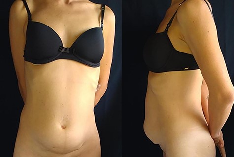 Abdominal wall with tumor invasion and bulging.