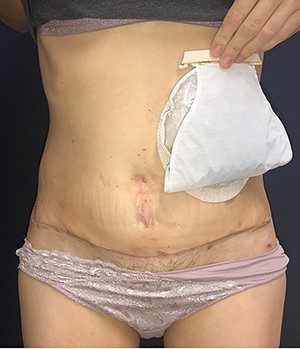 Appearance after 1 year of surgery.