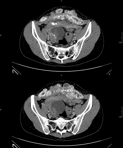 CT with heterogeneous solid-cystic lesions with contrast enhancement, septations and gross calcifications, in the topography of the uterine attachments, measuring 5.8 × 4.9 × 5.0 cm on the right (74 cm3 volume), 7.8 × 8.7 × 7.9 cm (278 cm3 volume) in the region of the rectouterine pouch and 2.9 × 2.4 × 2.3 cm (8.3 cm3 volume) in the left adnexal region.