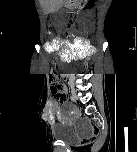 Abdominal wall CT with expansive lesion with soft tissue density, heterogeneous, with the appearance of a cluster of nodules, measuring 16.4 × 5.1 × 7.7 cm (334 cm3 volume) in the major latero-lateral, antero-posterior axes and longitudinal, respectively.
