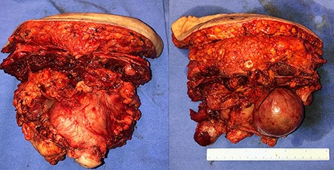 Surgical specimen of pan-hysterectomy with excision of the abdominal wall and cecectomy.