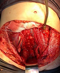 Pelvis after tumor excision, peritonectomy and lymphadenectomy.