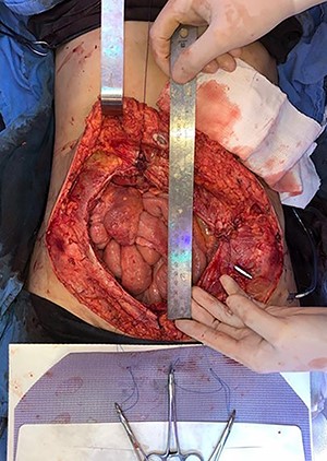Defect of the abdominal wall of 7 × 7 cm in the major axes.