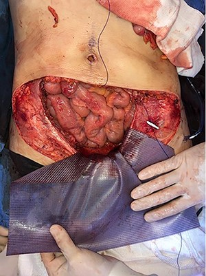 Mesh initially fixed on the pubic tubercle and Cooper’s ligament bilaterally.