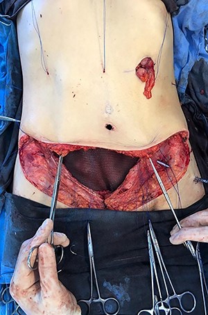 Mesh covering the abdominal defect with presentation of transfascial fixation points, with an overlap of 8 cm.