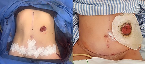 Final image of the surgery.